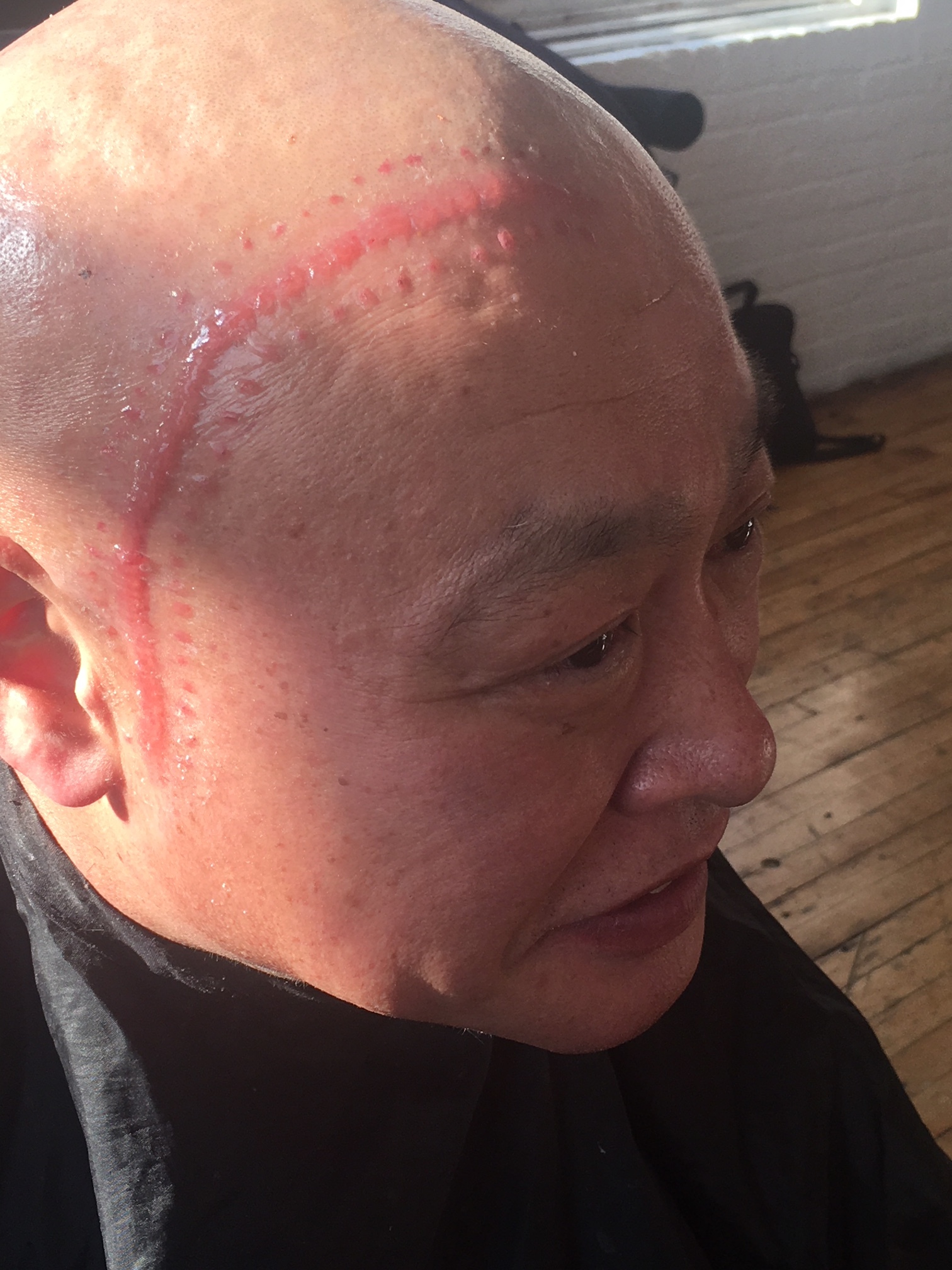 Healing 'brain surgery scar'