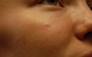 Cherry angioma after
