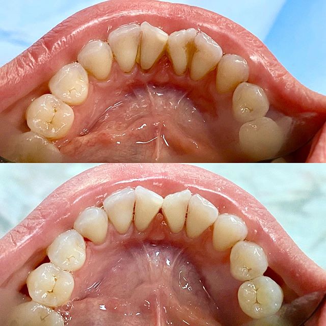 SCALE &amp; POLISH / BEFORE &amp; AFTER 
Call 0161 941 2048 to book in with Emily for a hygiene appointment 🦷 #butterflydental