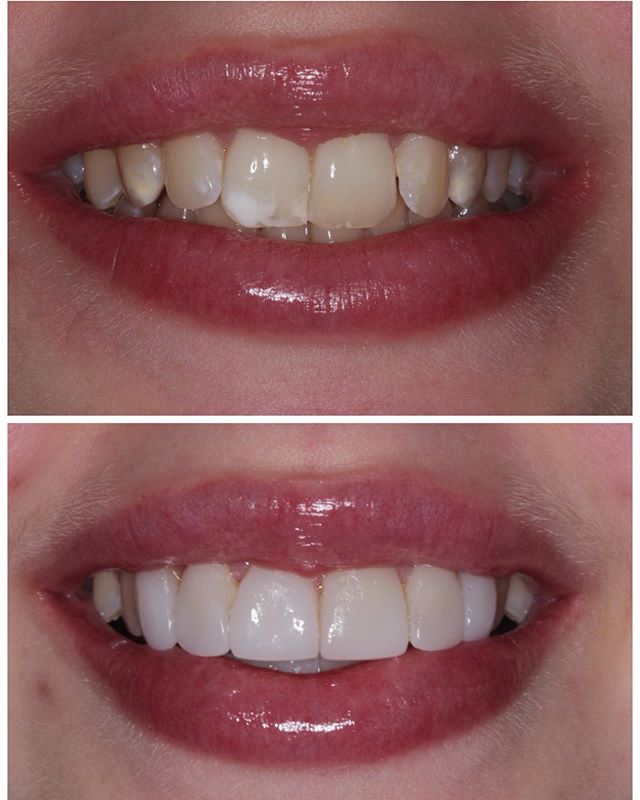 Amazing results for our lovely patient! If you would like any information regarding veneers/ cosmetics please give us a call on 01619412048 😁 #veneers #cosmetic #dentist #dentistry #altrincham #manchester