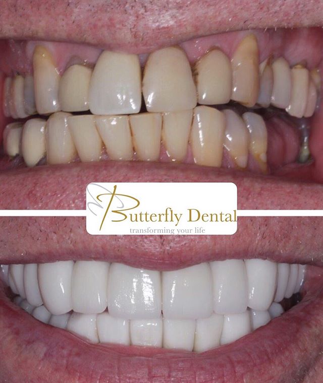 This incredible case consisted of a combination of veneers and crowns to improve not only aesthetics of the teeth but also the health and strength of them too.💪🏼This was all completed in as little as a few months!👏🏼 If you have any queries about 
