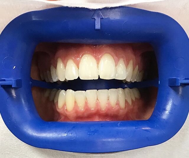 Suffering from the January blues? Why not brighten your day (and your smile!) by booking in for @philipszoom tooth whitening 🦷

DM or call 0161 941 2048 to book.