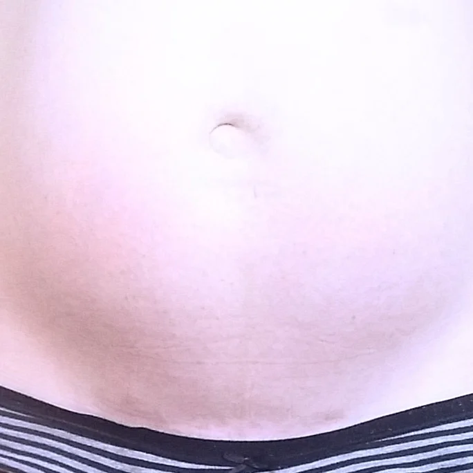 cesarean scar.jpg
