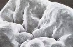 Fig 1. Note the irregularities in this typical permanent molar.