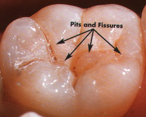 Fig 3. Normal anatomy of a lower molar before sealant.