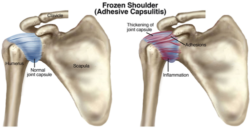 FrozenShoulder.jpeg