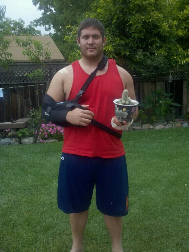 One Week Post-Operation. Check out the Cactus/Cast Combo. Palo Alto, June 2011