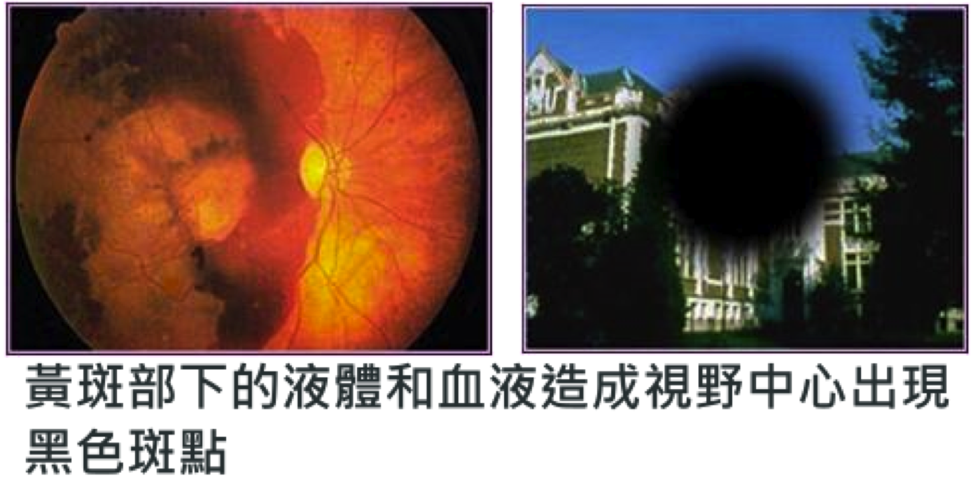 WET AMD with large hemorrhagic retinal area and scotoma in the vision