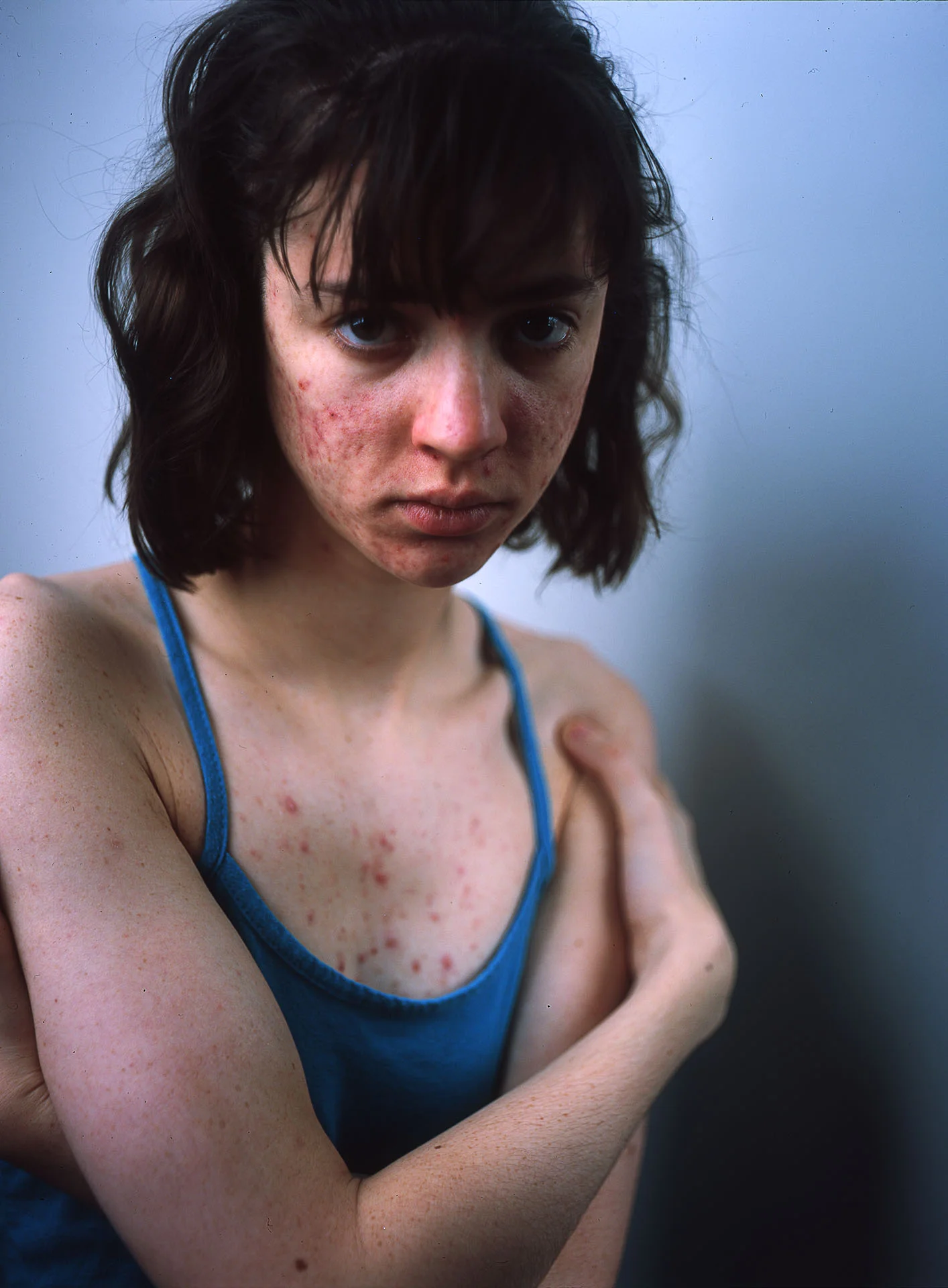 Acne.jpg
