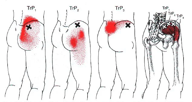 Gluteus Medius_0.jpg