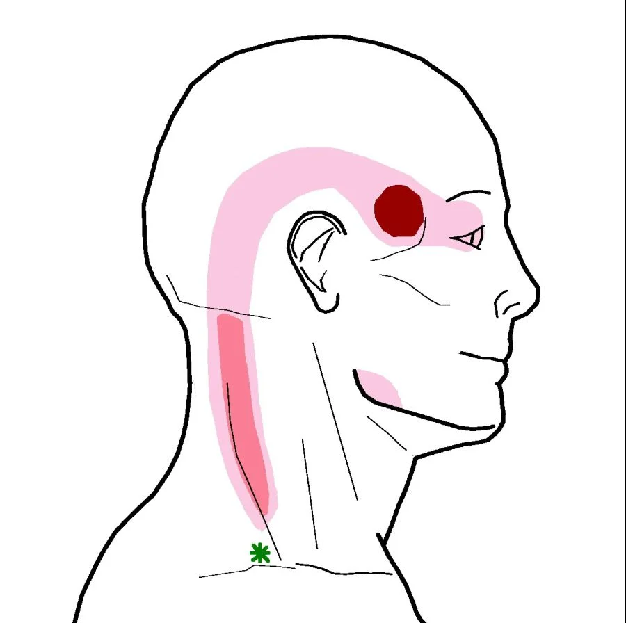 The most common trigger point in the Upper Trapezius muscle that refers up to the temple and behind the eyes.
