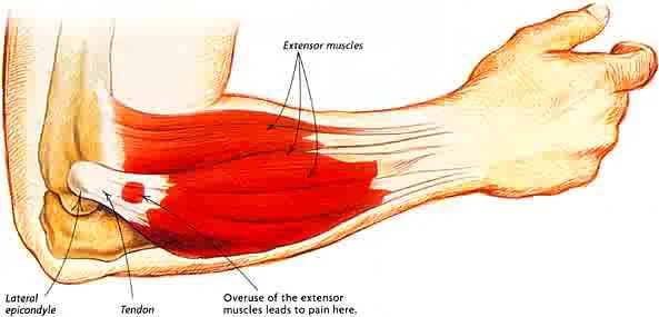 Tennis Elbow Fast Track Your Healing Kinfolk Physiotherapy Wellness Tennis Elbow Fast Track Your Healing Kinfolk Physiotherapy Wellness
