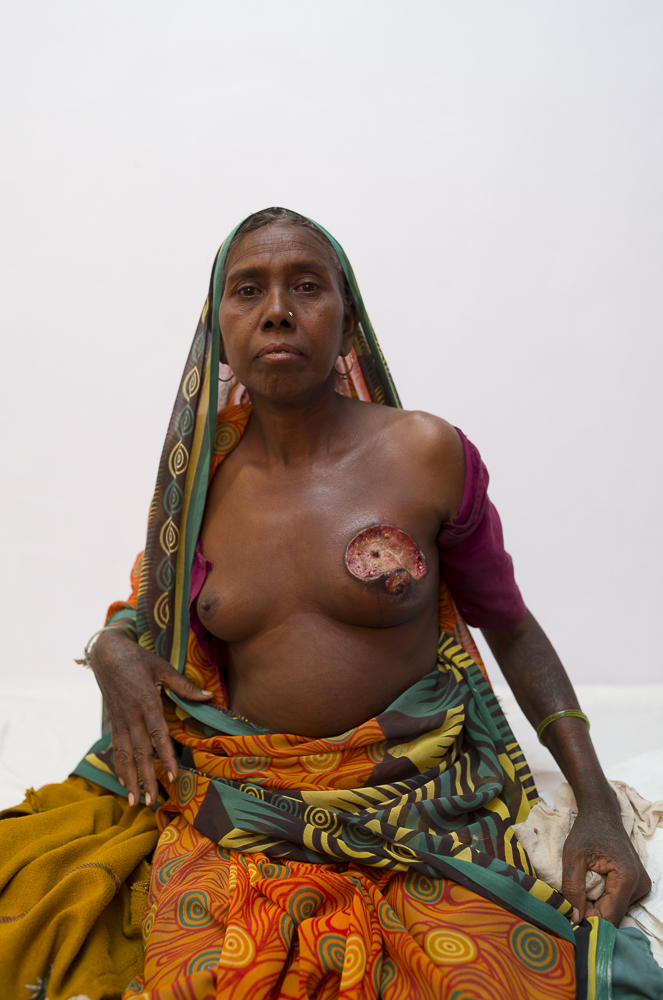  A patient in Melghat, India and a moment where as a photographer you're really left changed after the capture. During pre-operative rounds I was asked to shoot this patient.She is from the tribes surrounding the hospital and was awaiting for her mas