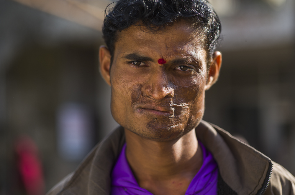  For every person operated on, there are those who come year after year to be turned away.&nbsp;  This young man could not speak, and his injuries that he had as a child are too severe to be operated on.&nbsp; 