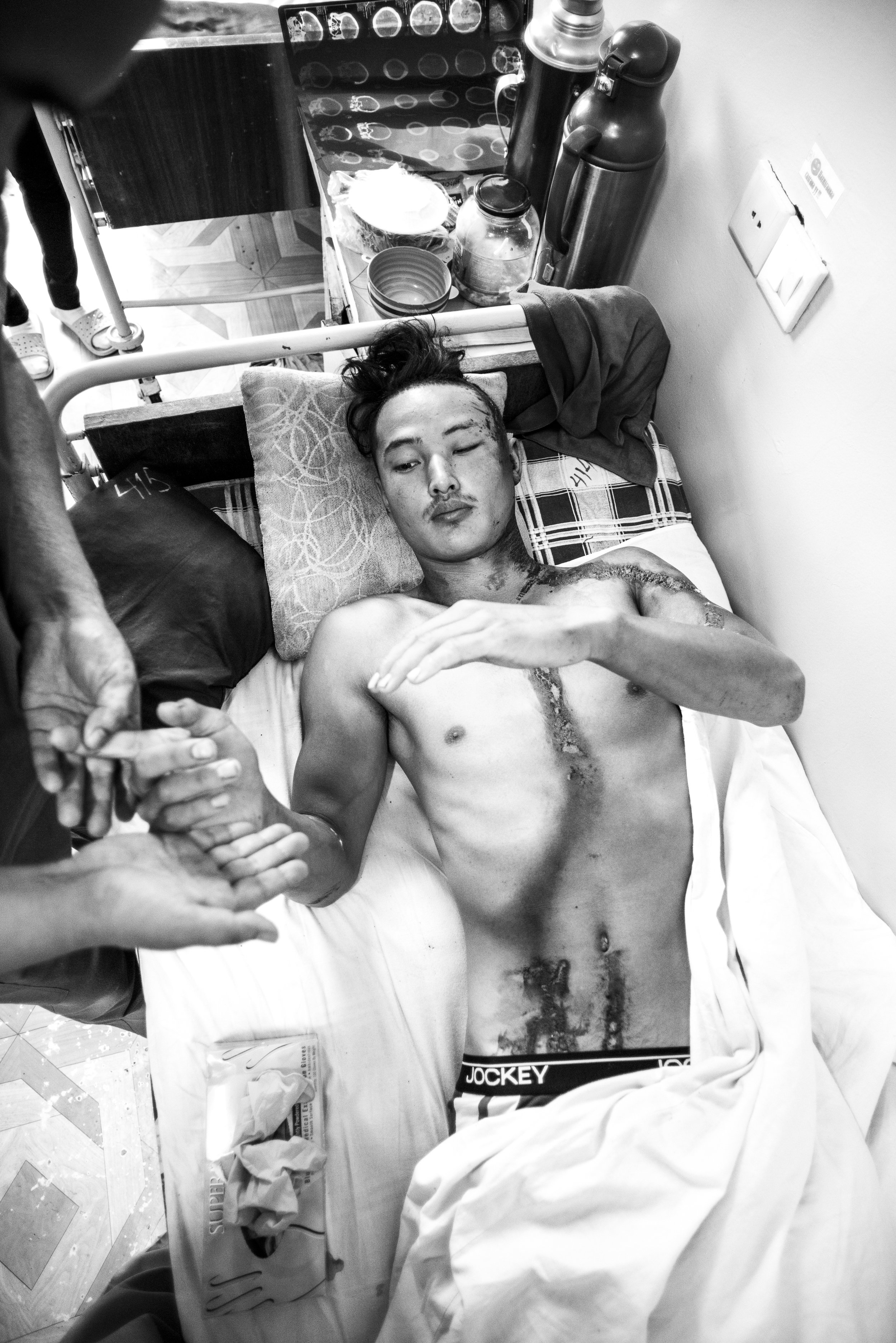 Moron, Mongolia. During our week in this small town in Northern Mongolia, the Interplast team triaged around 40 patients and quickly filled the operating list. On the second day, this young man who had been struck by lighting was brought to out attention, he was still in a state of shock when we met him and unable to speak. The lighting bolt left a path from his ear, through his chest and out his right leg. The Interplast team couldn't operate as he deteriorating, which brain scans further revealed swelling and anaesthesia would have posed a further risk. To this day I do not know if he recovered.