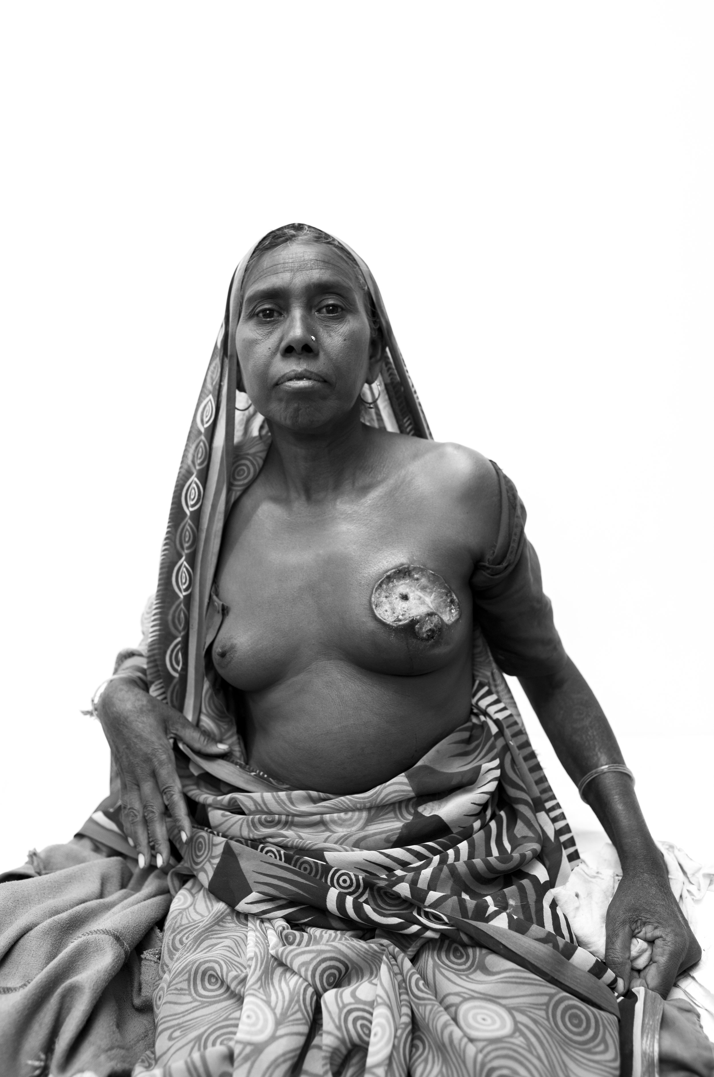  A patient in Melghat, India and a moment where as a photographer you're really left changed after the capture. During pre-operative rounds I was asked to shoot this patient.She is from the tribes surrounding the hospital and was awaiting for her mas