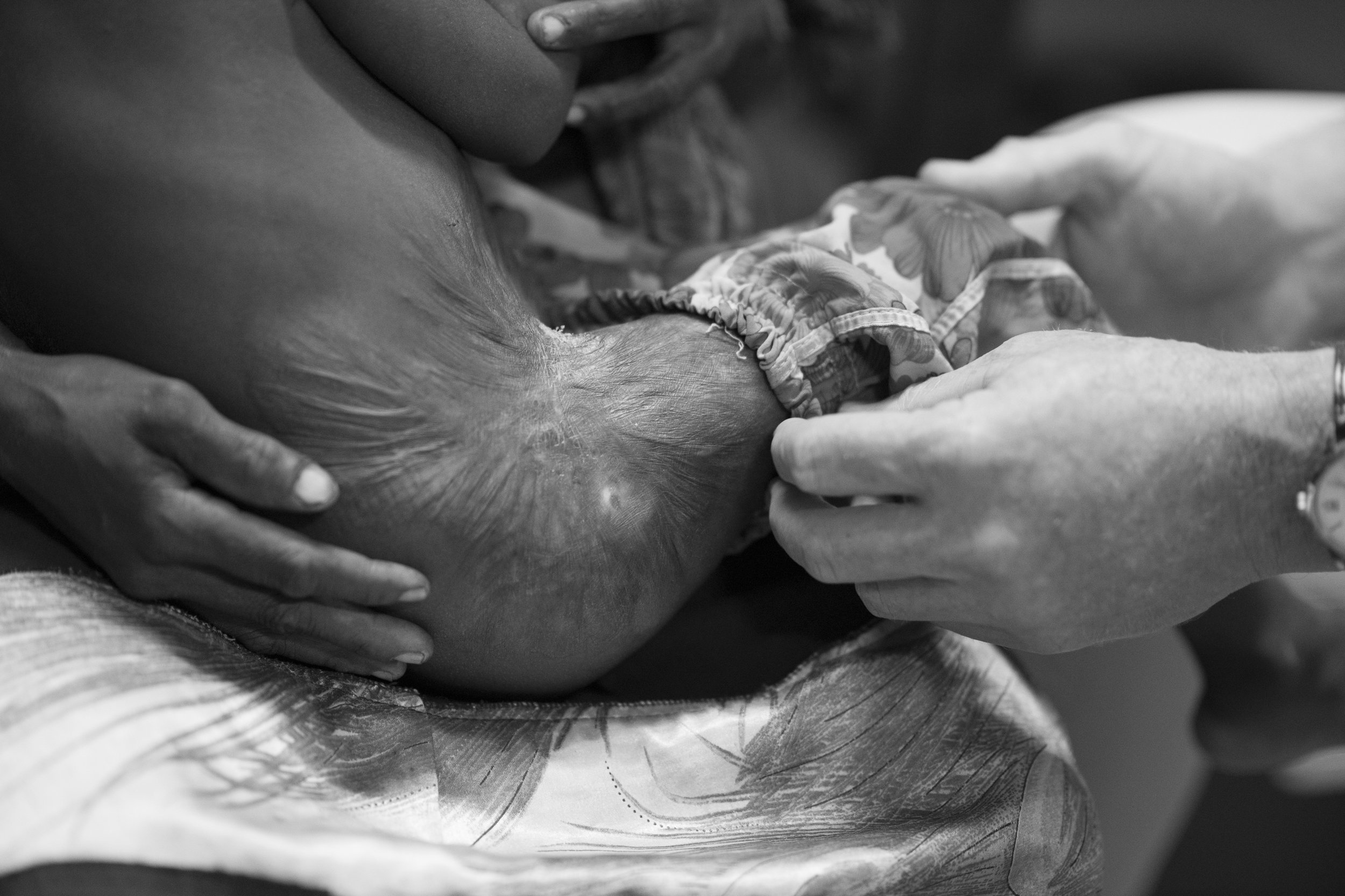  Vanimo, Papua New Guinea.  This young child has a severe burn covering her chest, hip and thigh.  The skin has contracted to the point where, at 3 years of age, she is unable to walk due to the tension. Whilst it's easy to concentrate on the immedia