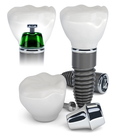 Implants