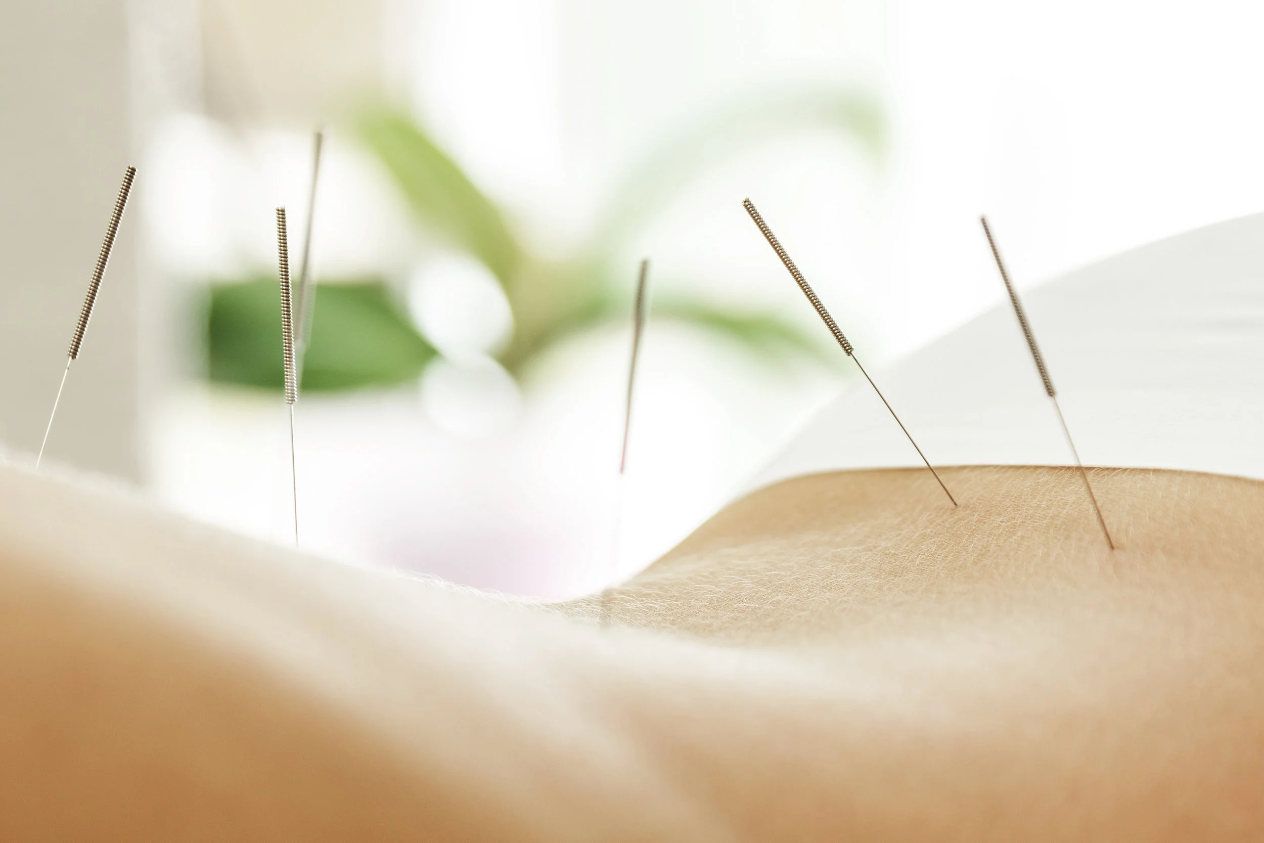 What is Acupuncture Treatment?
