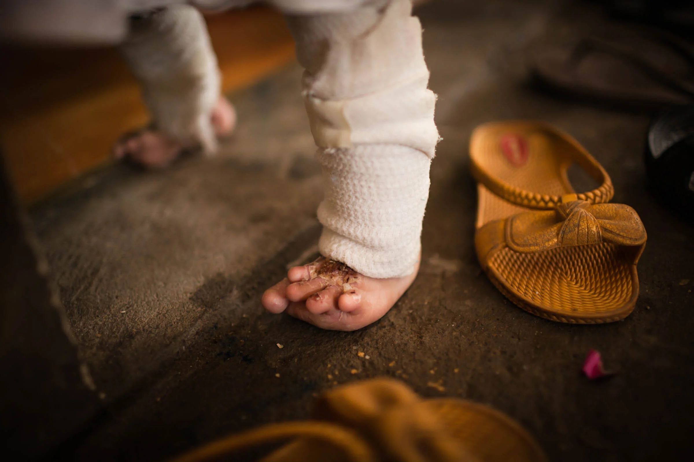  Detail of heavily bandaged foot of disabled child with skin disorder. 
