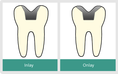 Inlay & Onlay