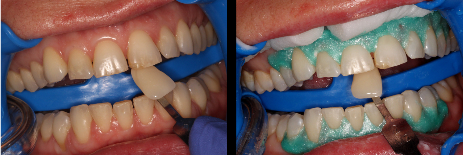 Teeth+Whitening.jpg