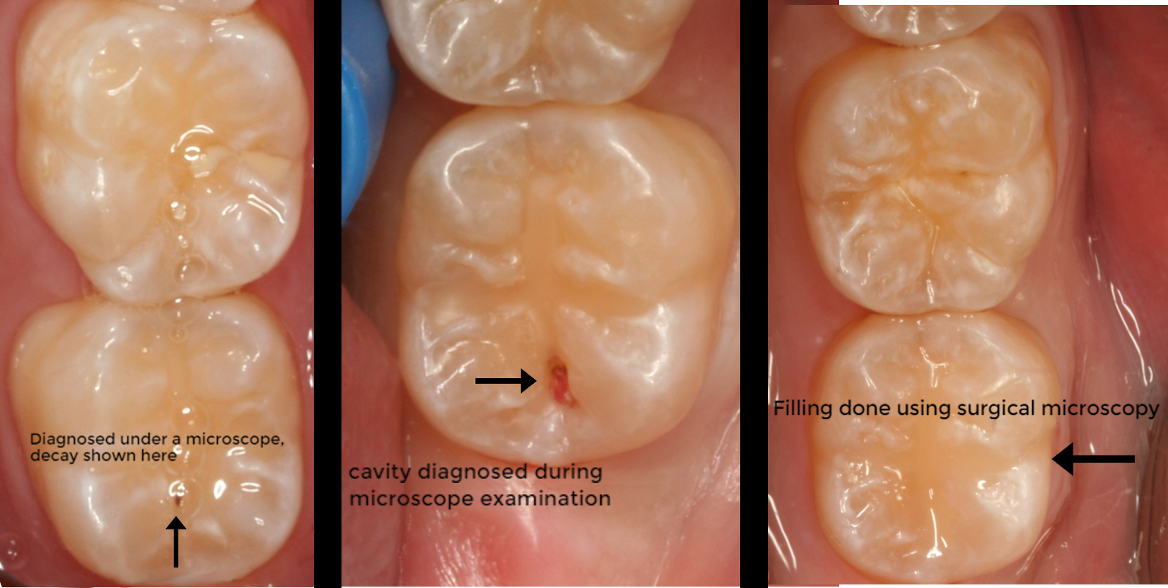 Composite Fillings 1.jpg