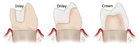 dental-inlay-onlay-and-crown.jpg