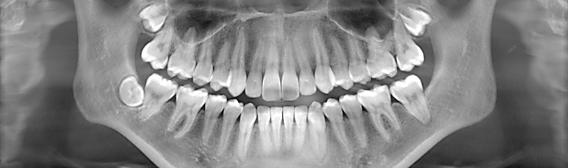   With digital dental X-rays, your dentist or other dental professional is able to immediately see your teeth and jaw bones. This means that assessment and diagnosis is virtually instantaneous.  