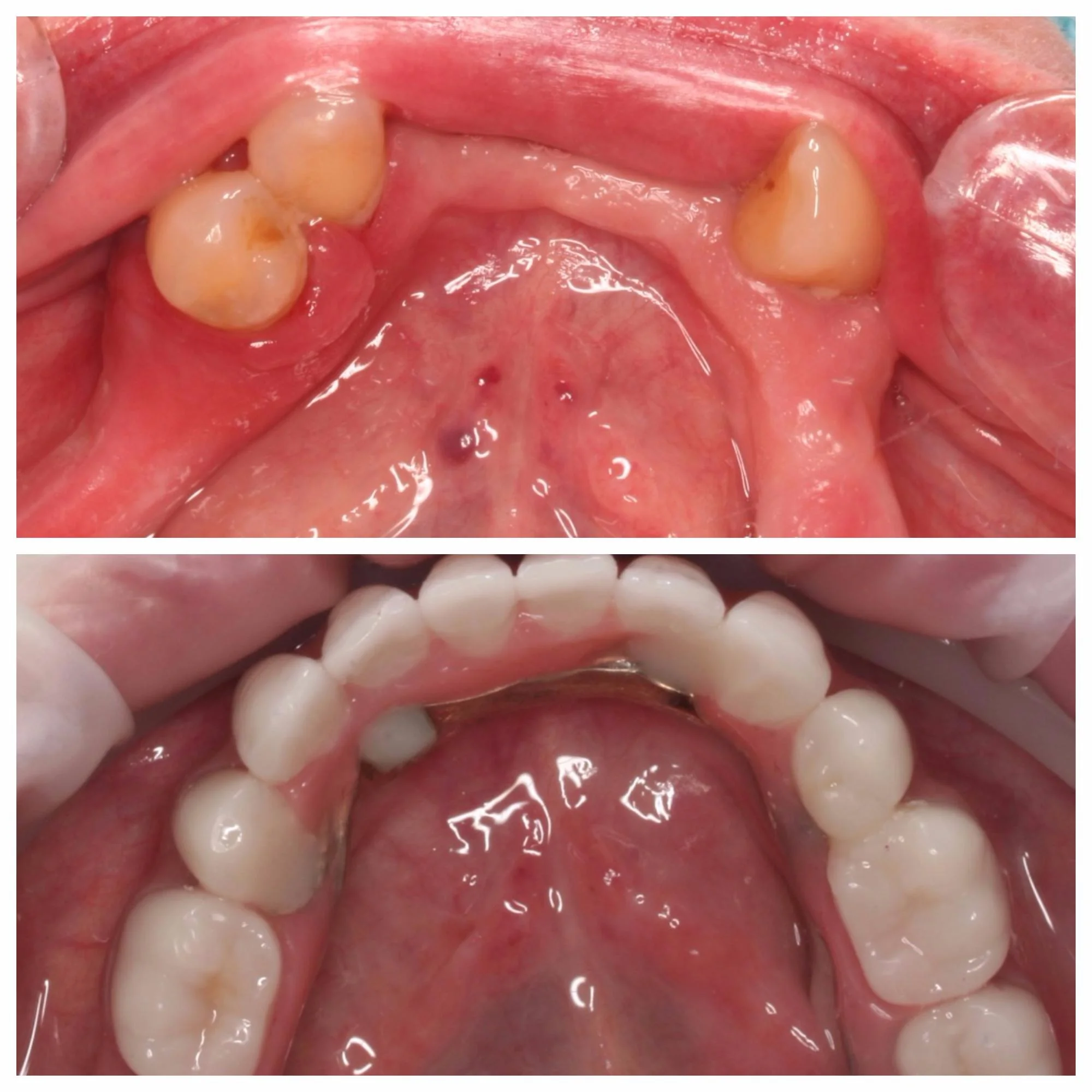 Lower Arch Implants + Restoration