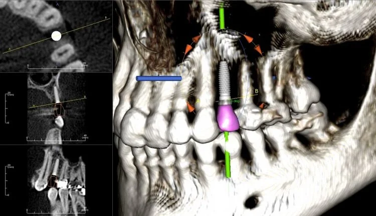Here at Santa Monica Esthetic Dentistry we use Cone Beam CT scans are computer guided sugery guides 