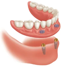 snap-on-dentures.jpg