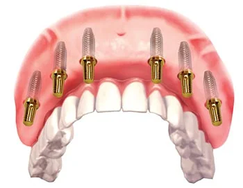 All on 4 and All on 6 Dental Implant Bridges/Permanent Teeth Solutions