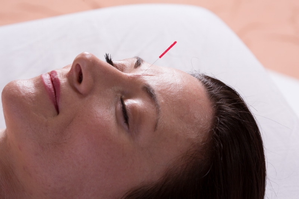 Acupuncture