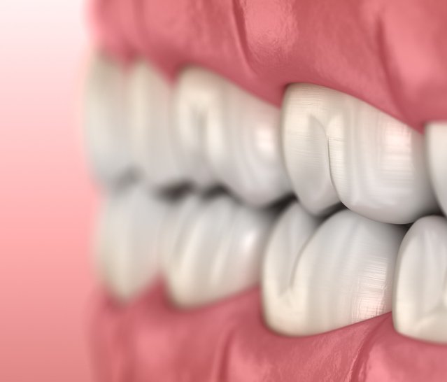 Toothaches and Biomechanics — Dr. Scott Solomons