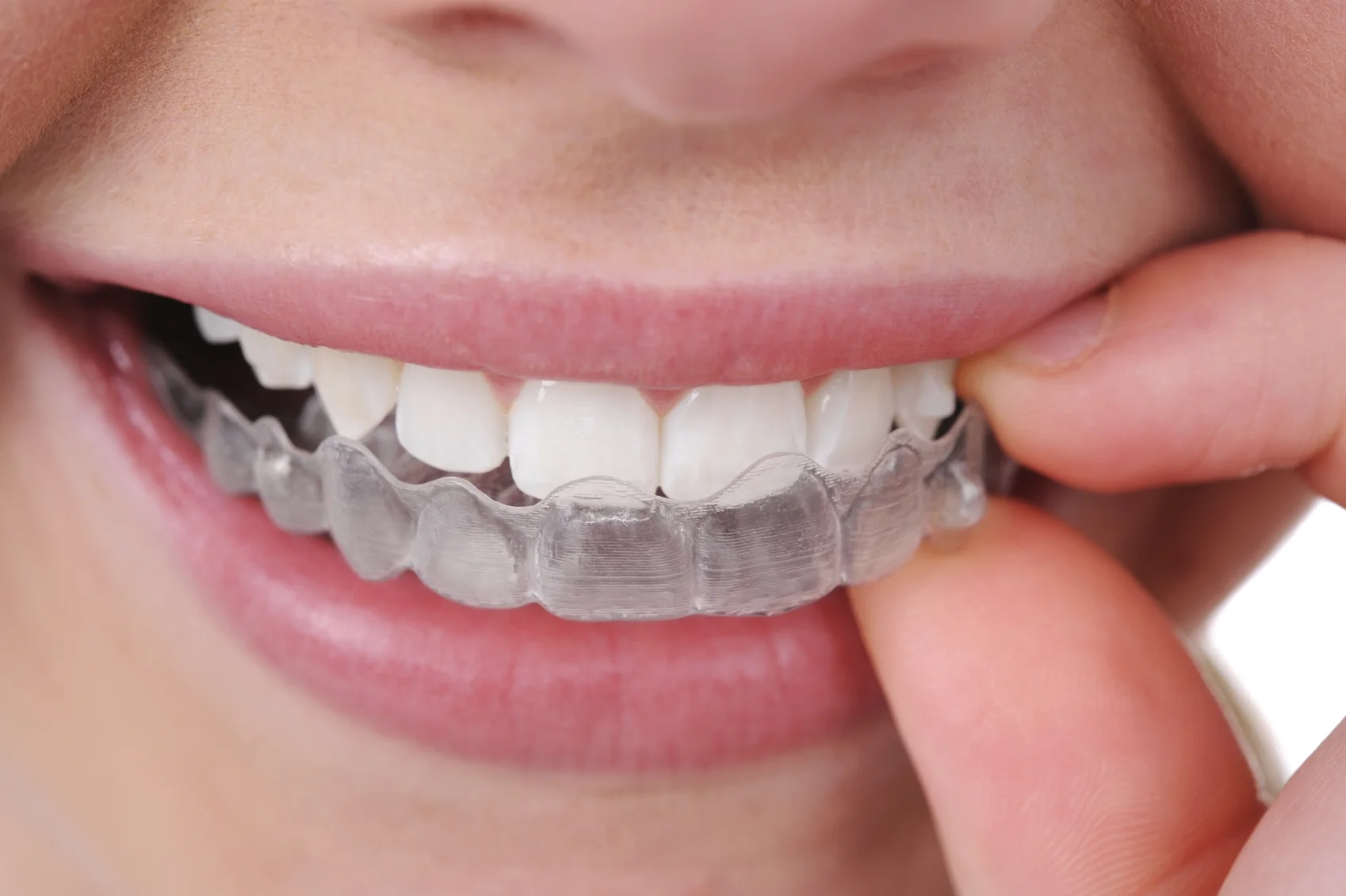 invisalign.jpg