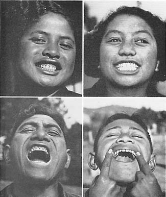 Typical Maori teeth BEFORE a Western Diet was introduced Photos courtesy of Weston A. Price