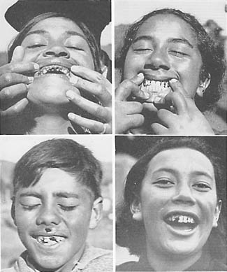 Typical Maori teeth AFTER a Western Diet was introduced Photos Courtesy of Weston A. Price