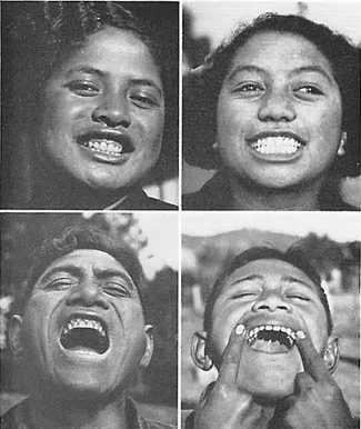 Typical Maori teeth AFTER a Western Diet was introduced Photos Courtesy of Weston A. Price