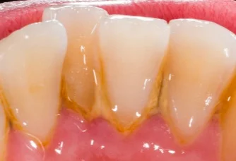 plaque and gingivitis