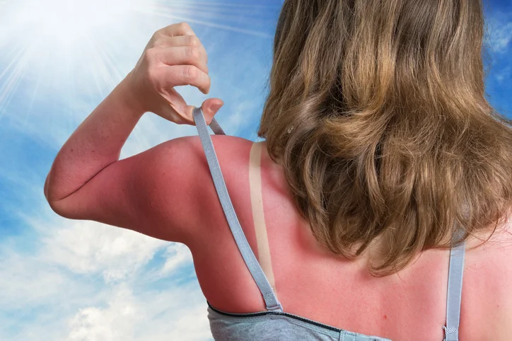 Sunburn.jpg
