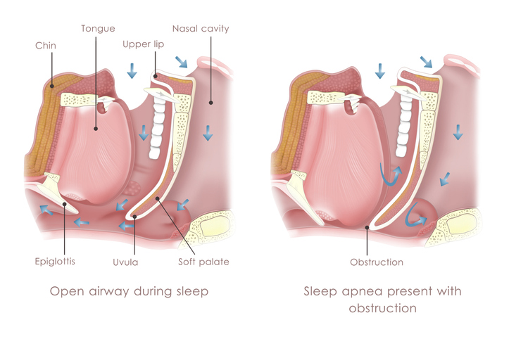 Sleep Apnea Diagram.jpg