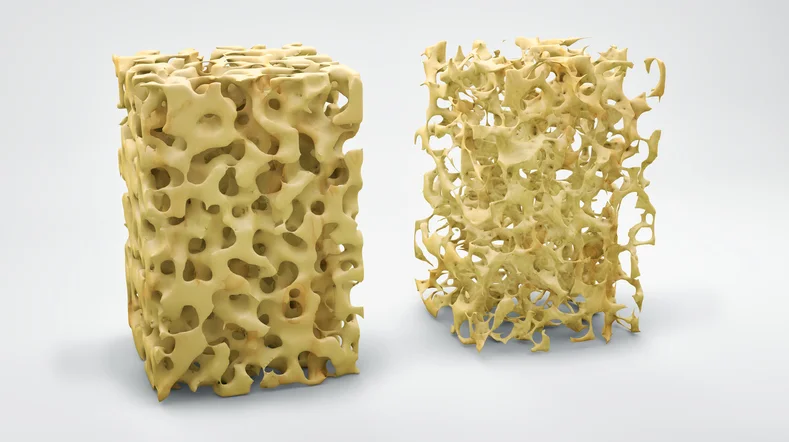 Osteoporosis Bone Comparison.jpg