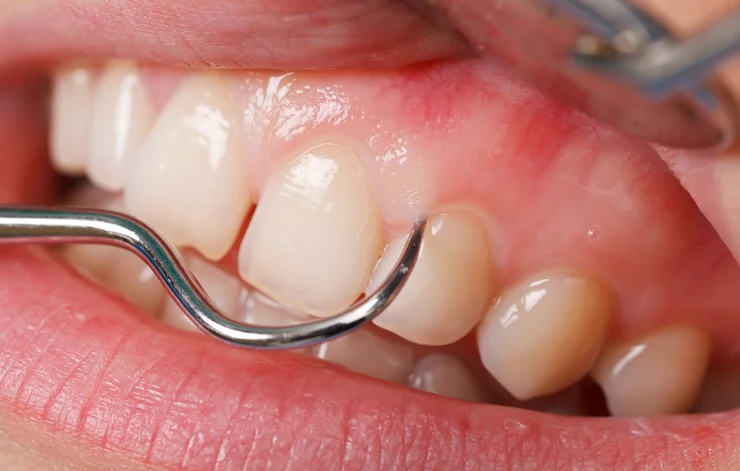 Scraping Teeth.jpg