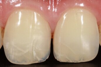 Cracked+teeth.jpg