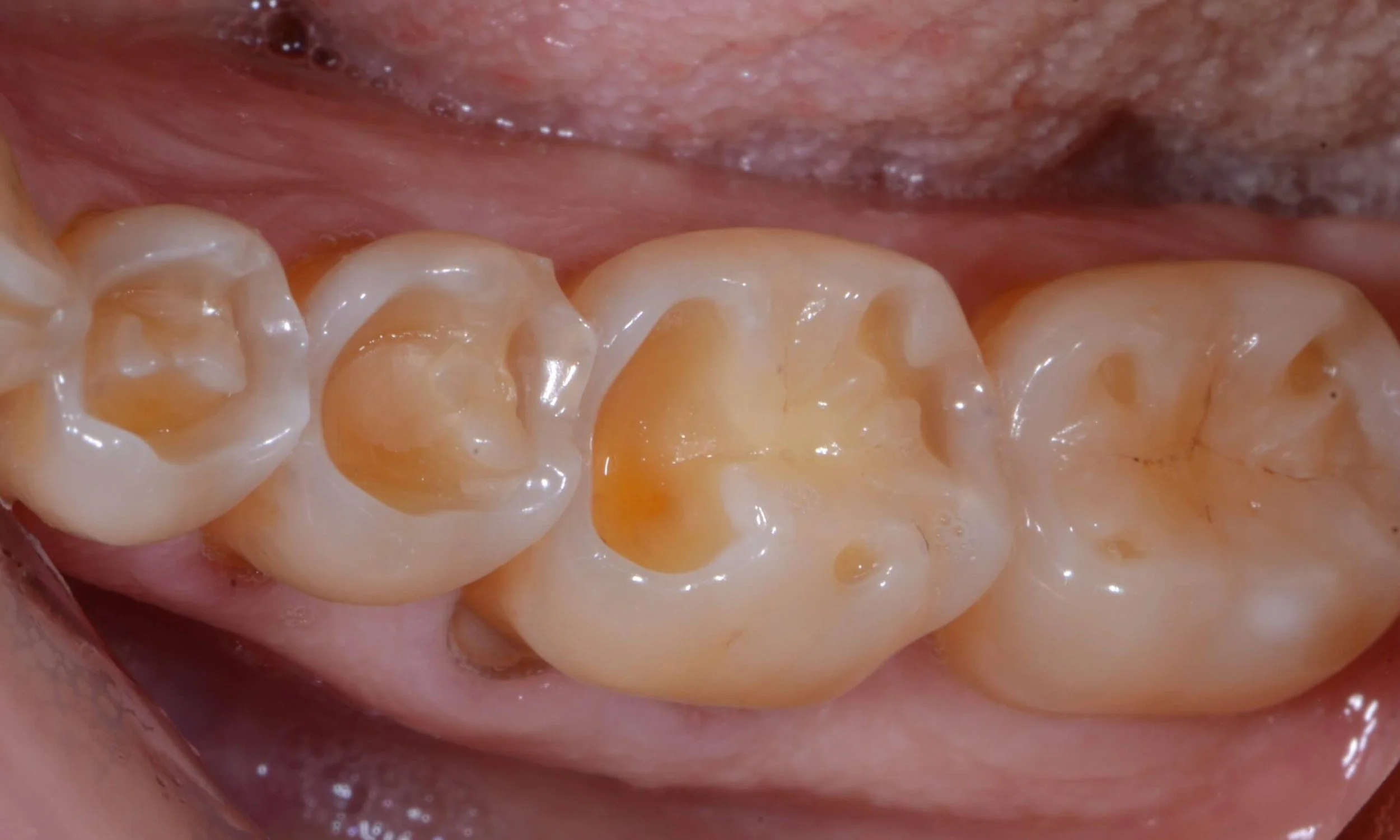Tooth Erosion The Constant Battle Between Remineralization and