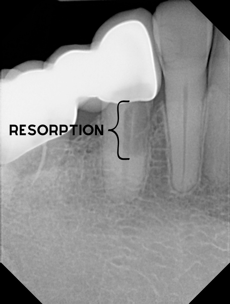 Root Resorption Dentition: Traitement Résorption Dentaire – KOSE