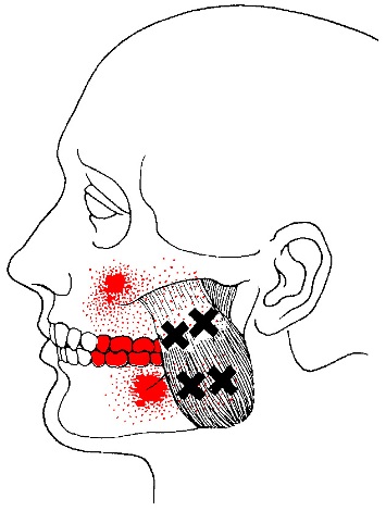 masseter-trigger-points1.jpg