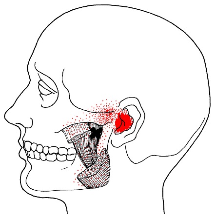 masseter-trigger-points3.jpg