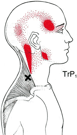 travell_trapezius_trigger_point3_lg__1_2_827.gif